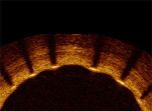 Mistent®-Coronary-Drug-Eluting-Stent-System235